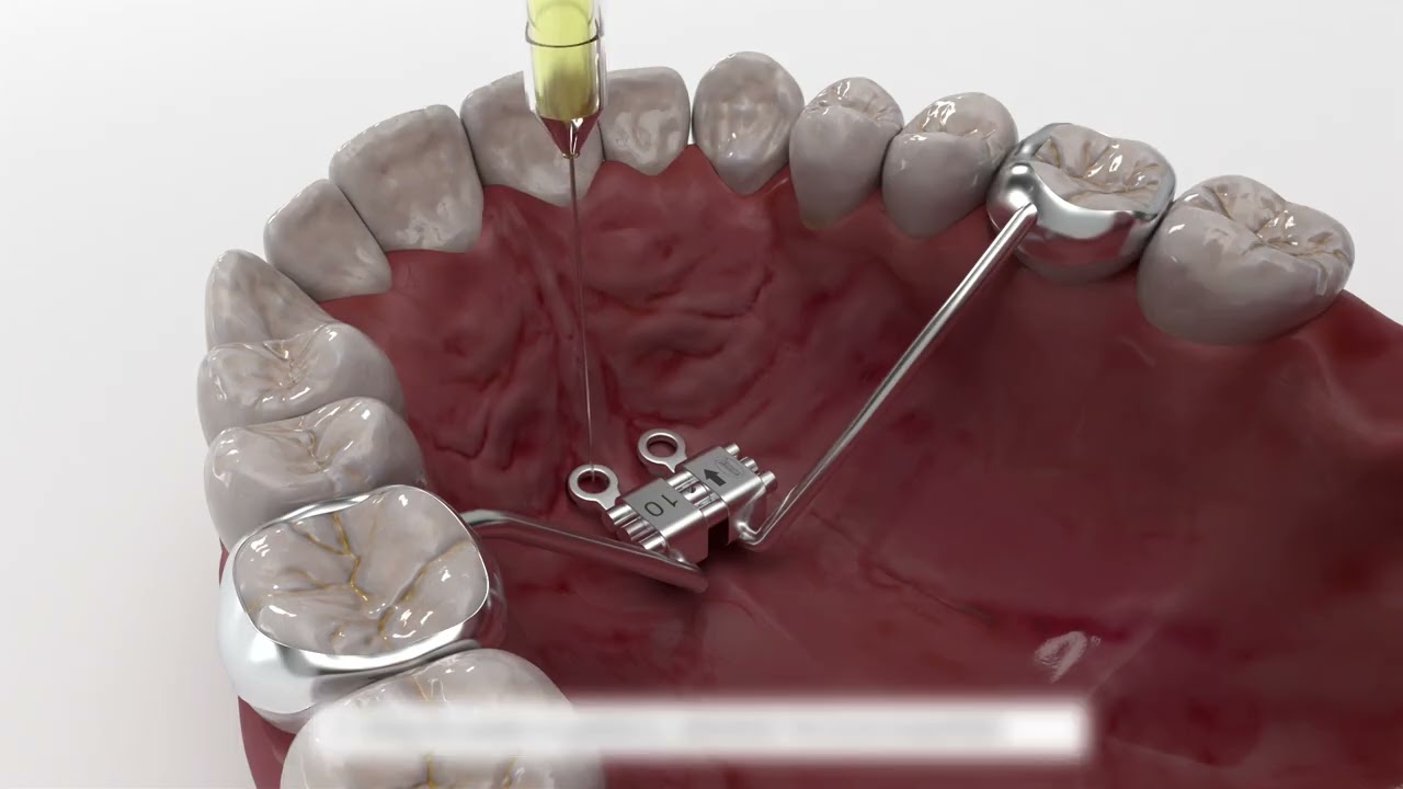 3D Printed Metal Maxillary Expanders With TAD Appliances From DB Orthodontics