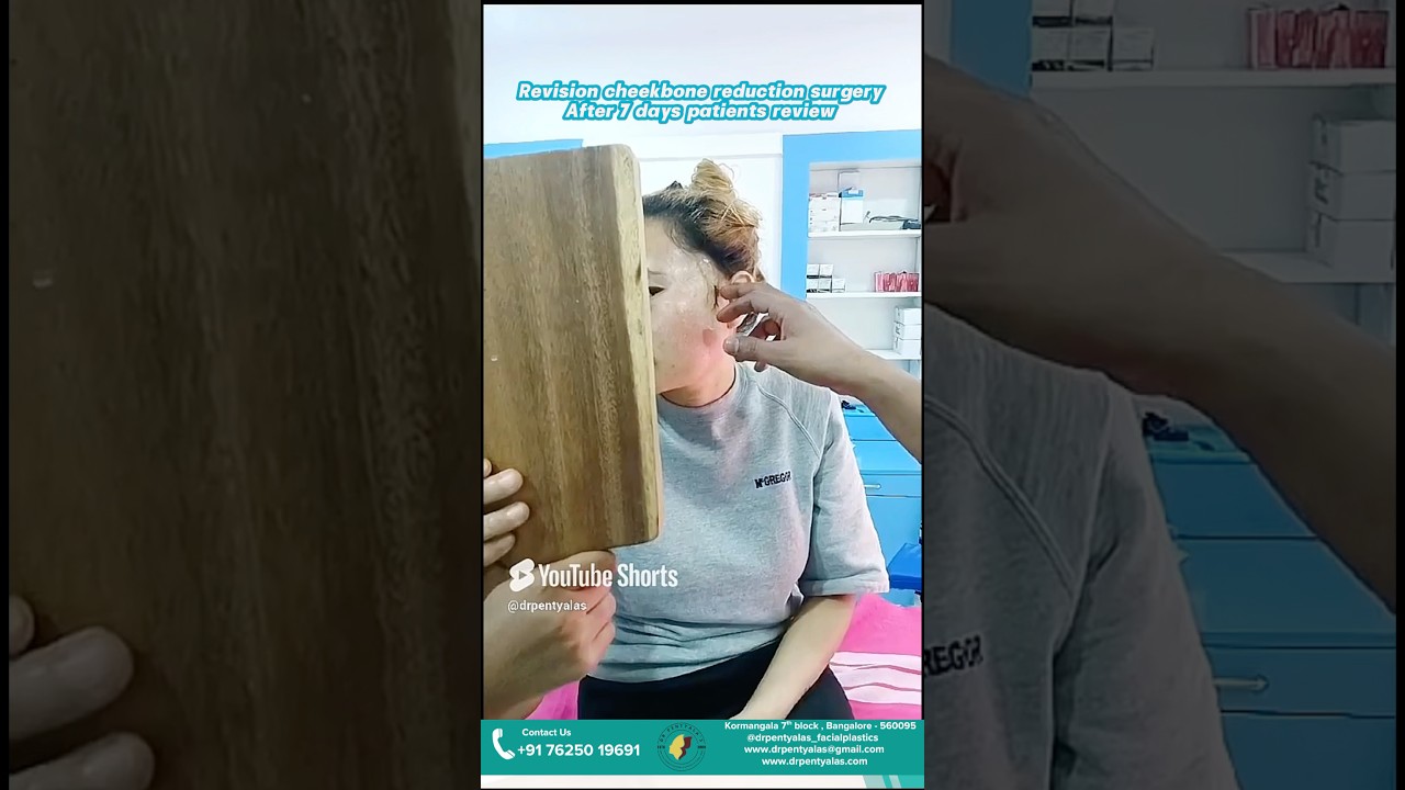 Revision cheekbone reduction surgery review 