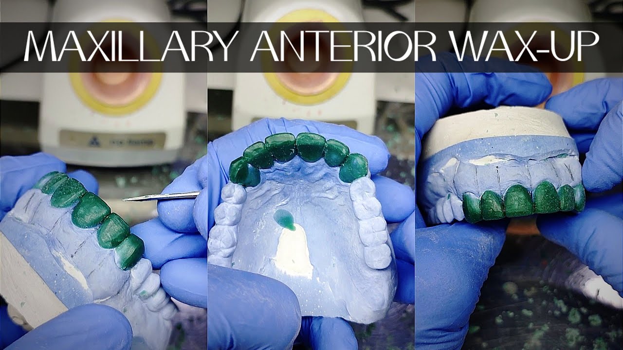 MAXILLARY ANTERIOR WAX UP FOR FULL ARCH REHAB|STEP BY STEP CARVING WITH ANNOTATIONS