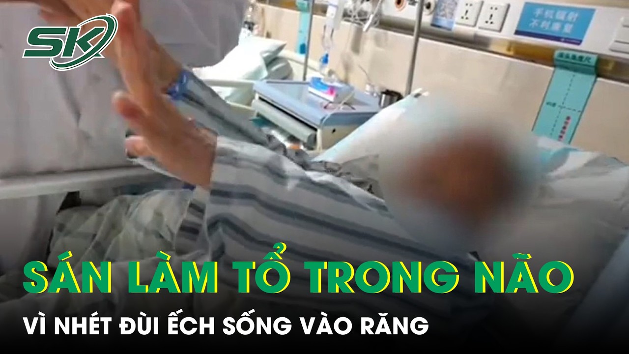 Nh&eacute;t đ&ugrave;i ếch sống v&agrave;o răng, người phụ nữ 61 tuổi bị s&aacute;n k&yacute; sinh, l&agrave;m tổ trong n&atilde;o | SKĐS