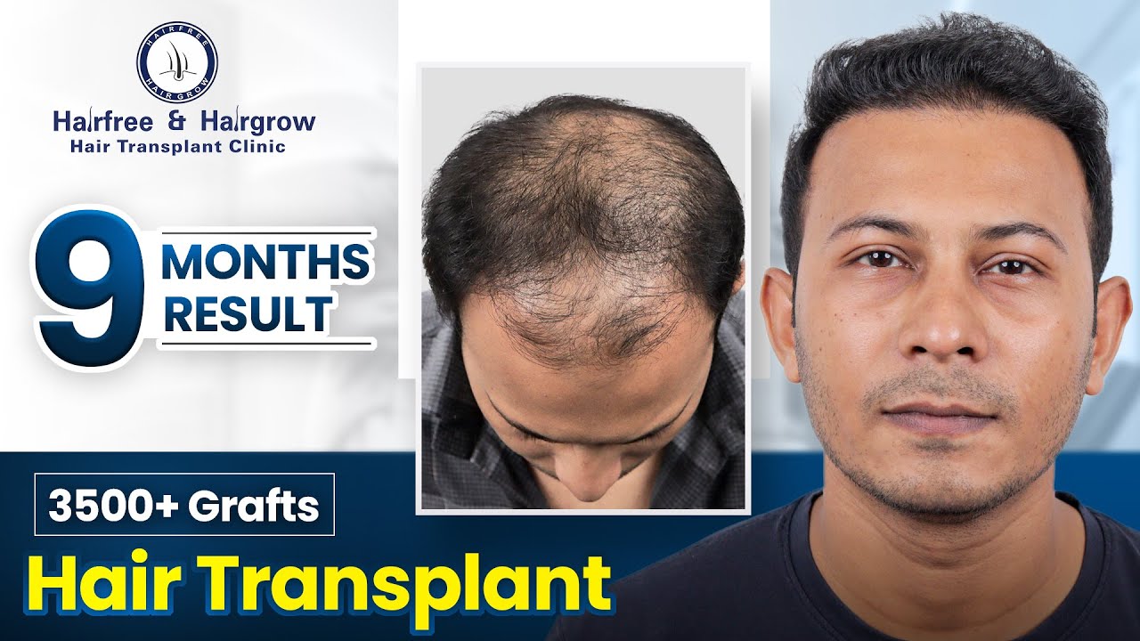 Grade 5 Hair Transplant in Surat | Stunning Hair Transplant Results and Cost #hairtransplant