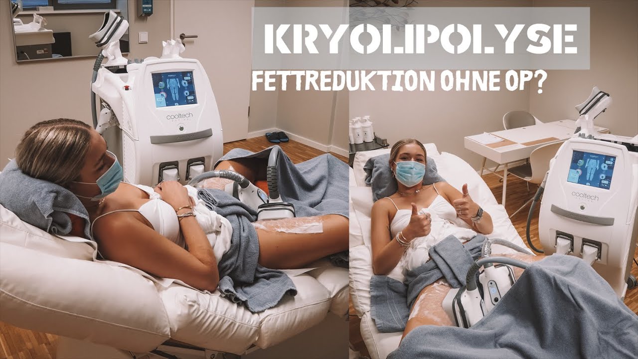 KRYOLIPOLYSE - Fettreduktion OHNE OP und ohne Bewegung? 😱❄️