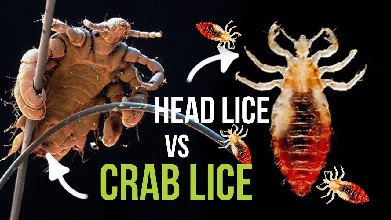 Crab Lice vs Head Lice - What is the Difference?