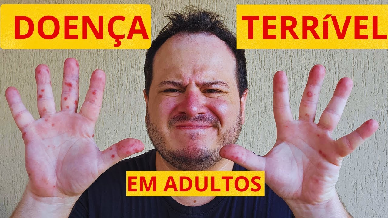 Mão-Pé-Boca - Como Aliviar as Dores e Desconfortos e a Minha Experiência