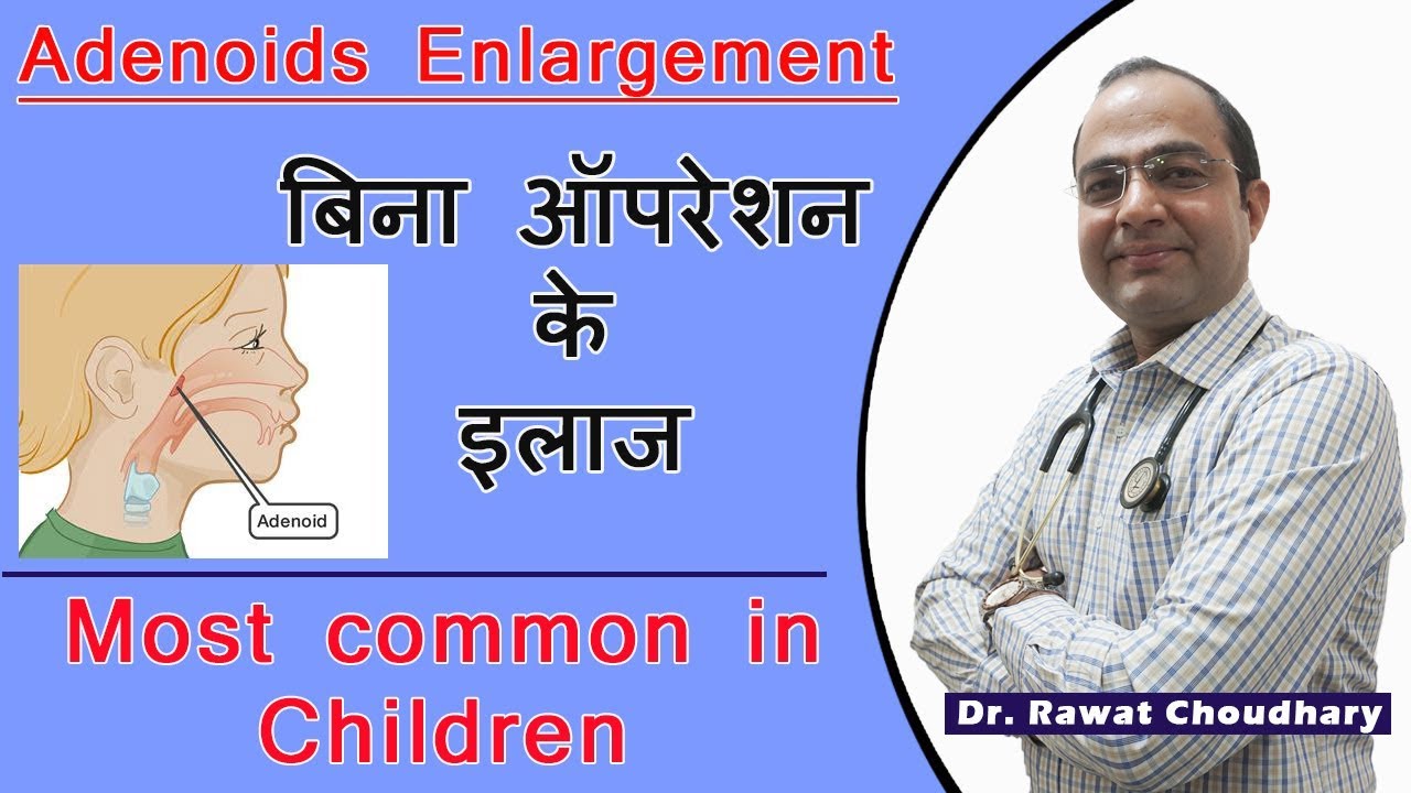 Adenoids Enlargement | Cure Without Operation | Most Common in Children