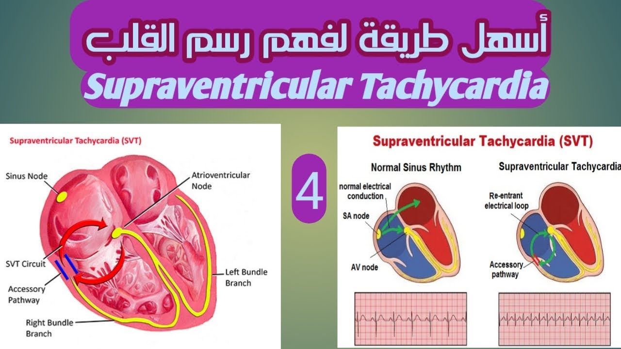 التسارع فوق البطينى SUPRAVENTRICULAR TACHYCARDIA, SVT رسم القلب الرجفة الأذينيه والتسارع فوق البطين