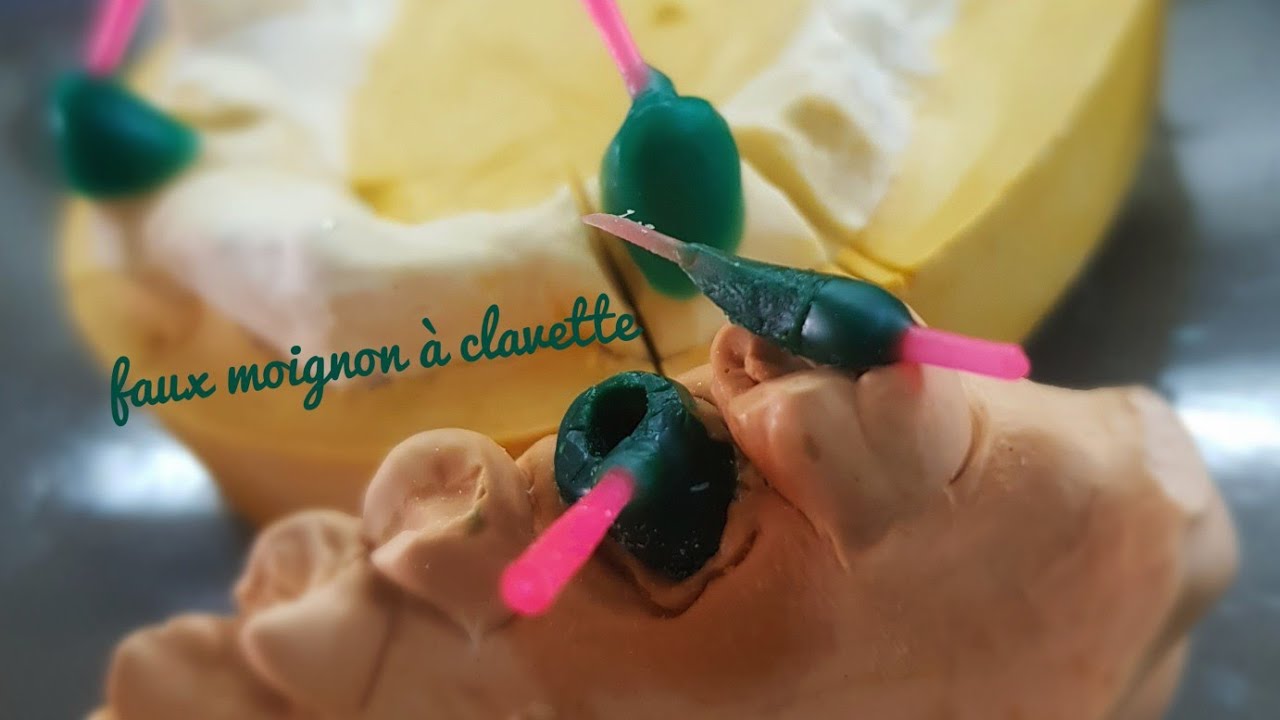 Faux moignon à clavette réalisation de toutes les étapes  de sculpture  (prothèse  conjointe)