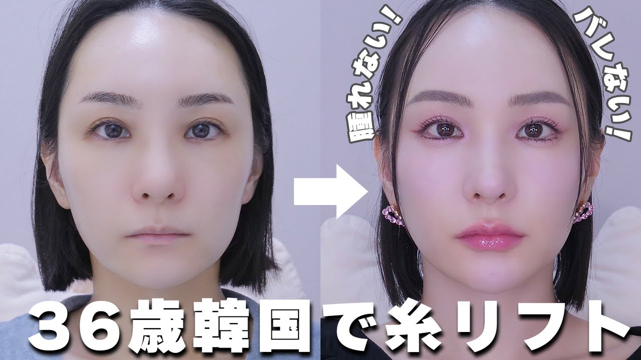 30代糸リフト12本正直レビュー!! 韓国美容課金🇰🇷/リフトアップ/美容整形/若返り