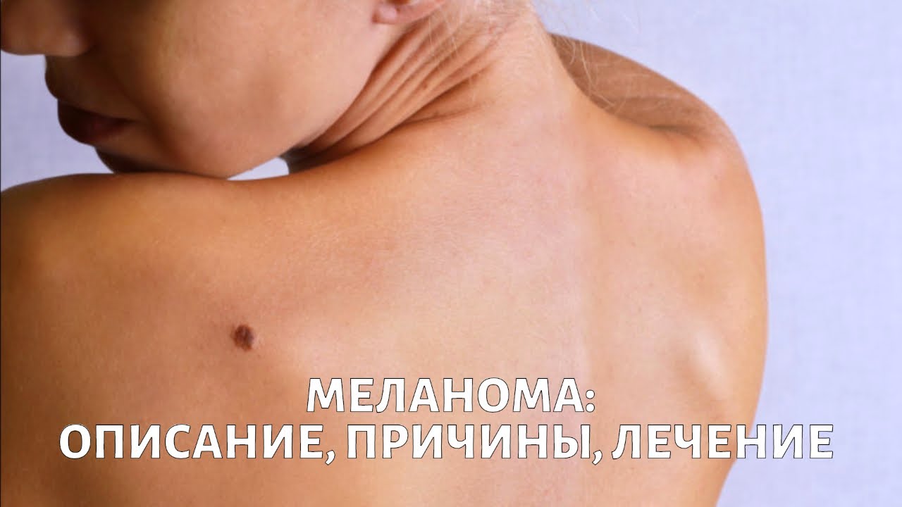 Меланома. Вопросы выживания