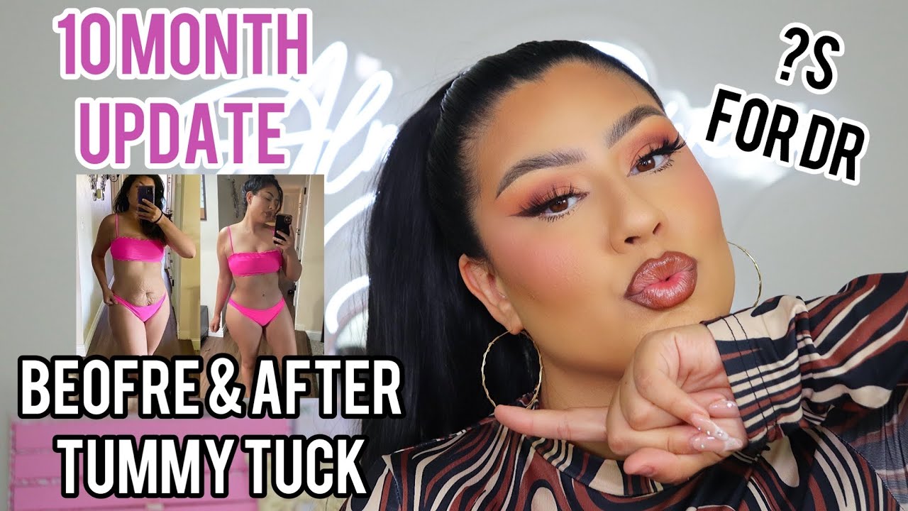 10 MONTH TUMMY TUCK POST OP UPDATE * SOME CONCERNS* Alma Rivera Beauty