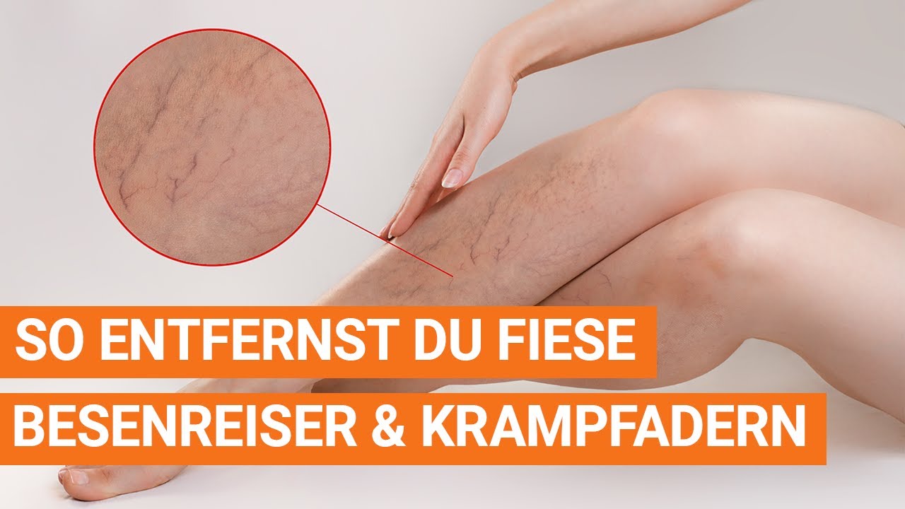 So entfernst du fiese Besenreiser und Krampfadern