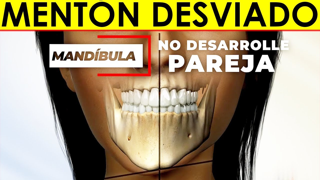 ¿Cómo ALINEAR mi ROSTRO si tengo la MANDÍBULA DESVIADA? Tratamiento para CORREGIR tu MENTON DESVIADO