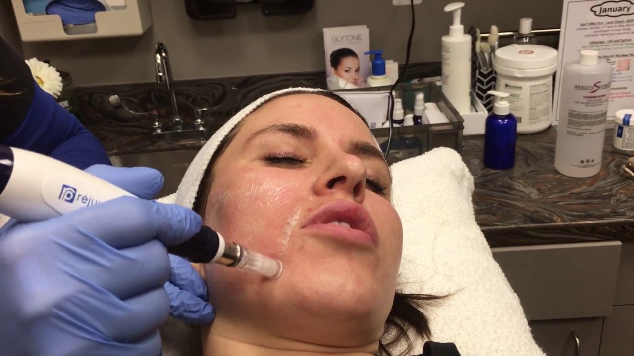 Microneedling, a Collagen Induction Therapy