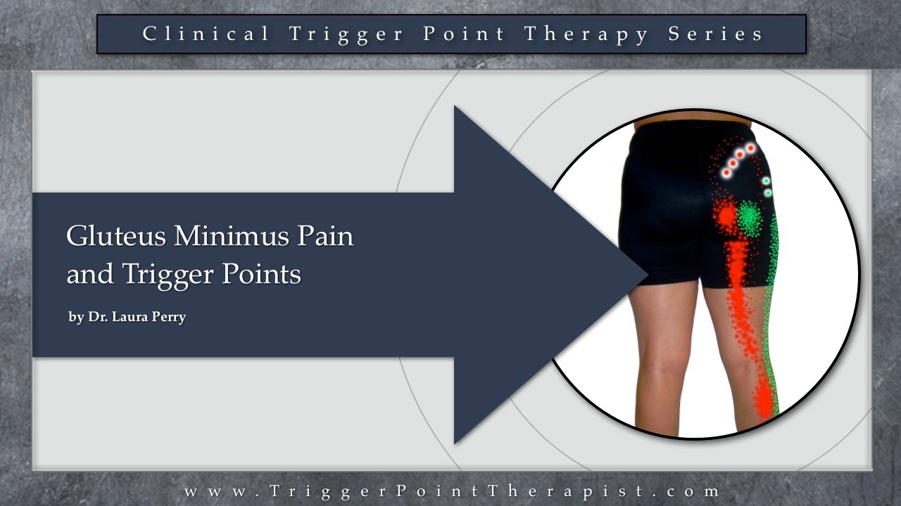 Gluteus Minimus Pain and Trigger Points