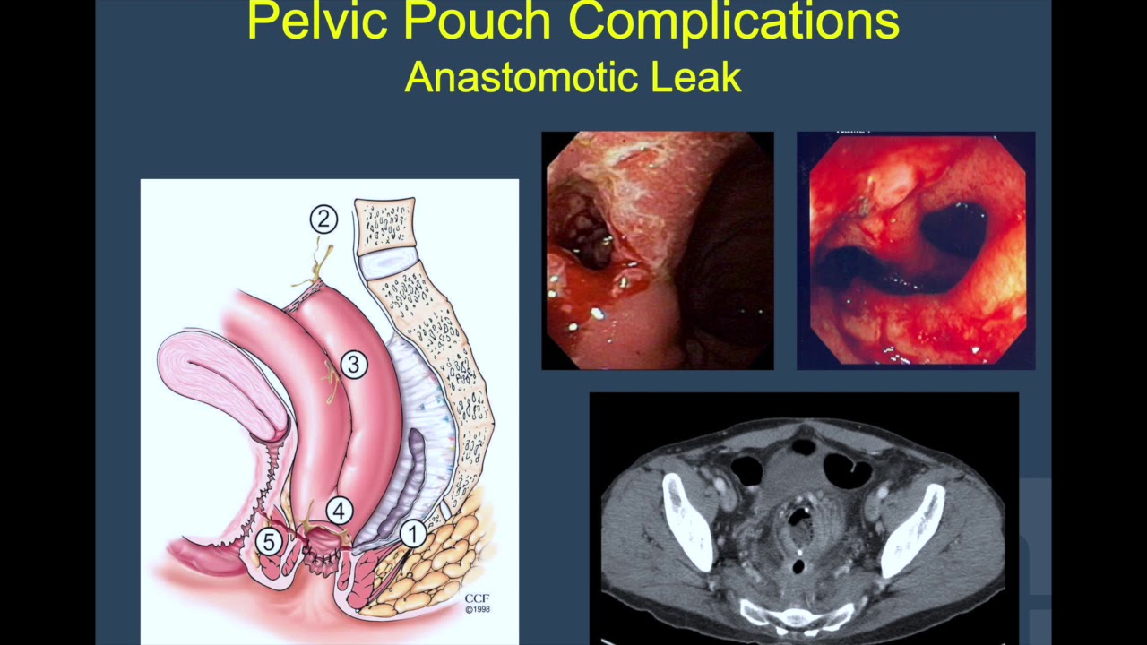 Everything You Always Wanted to Know About Pelvic Pouch Surgery - Dr Beatrice Dionigi