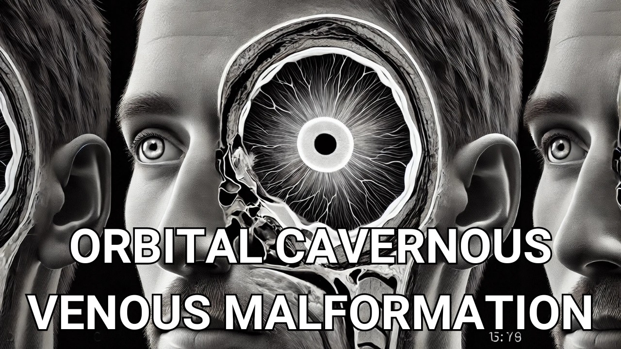 Кавернозная венозная мальформация орбиты 👁️ КТ и МРТ
