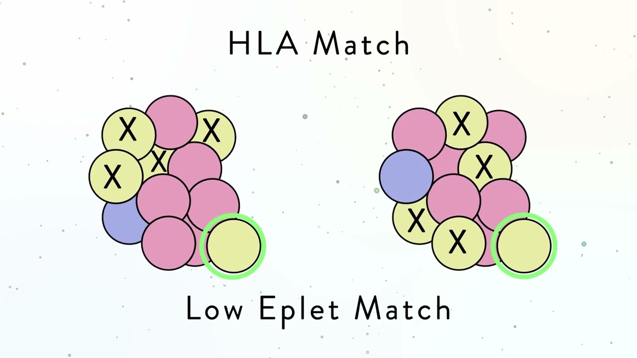 Eplets: Can They Improve Kidney Donor Matching?