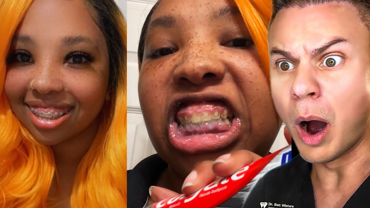 She Had Braces On For 11 YEARS!?