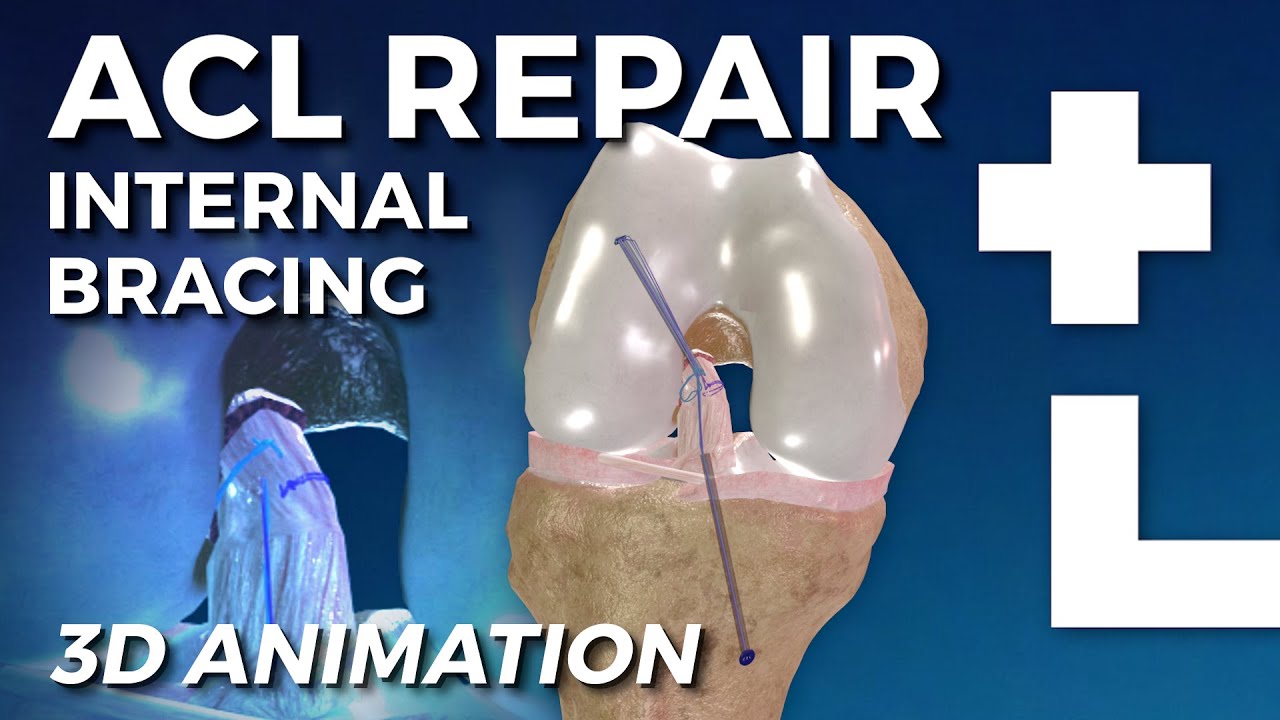 Internal Bracing ACL repair 3d animation - Dworska hospital&reg;