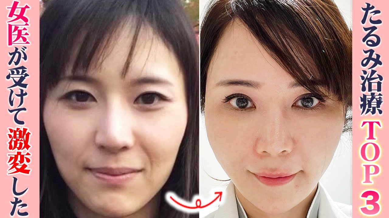 【女医が教える】過去に受けて激変したオススメたるみ治療ベスト3！