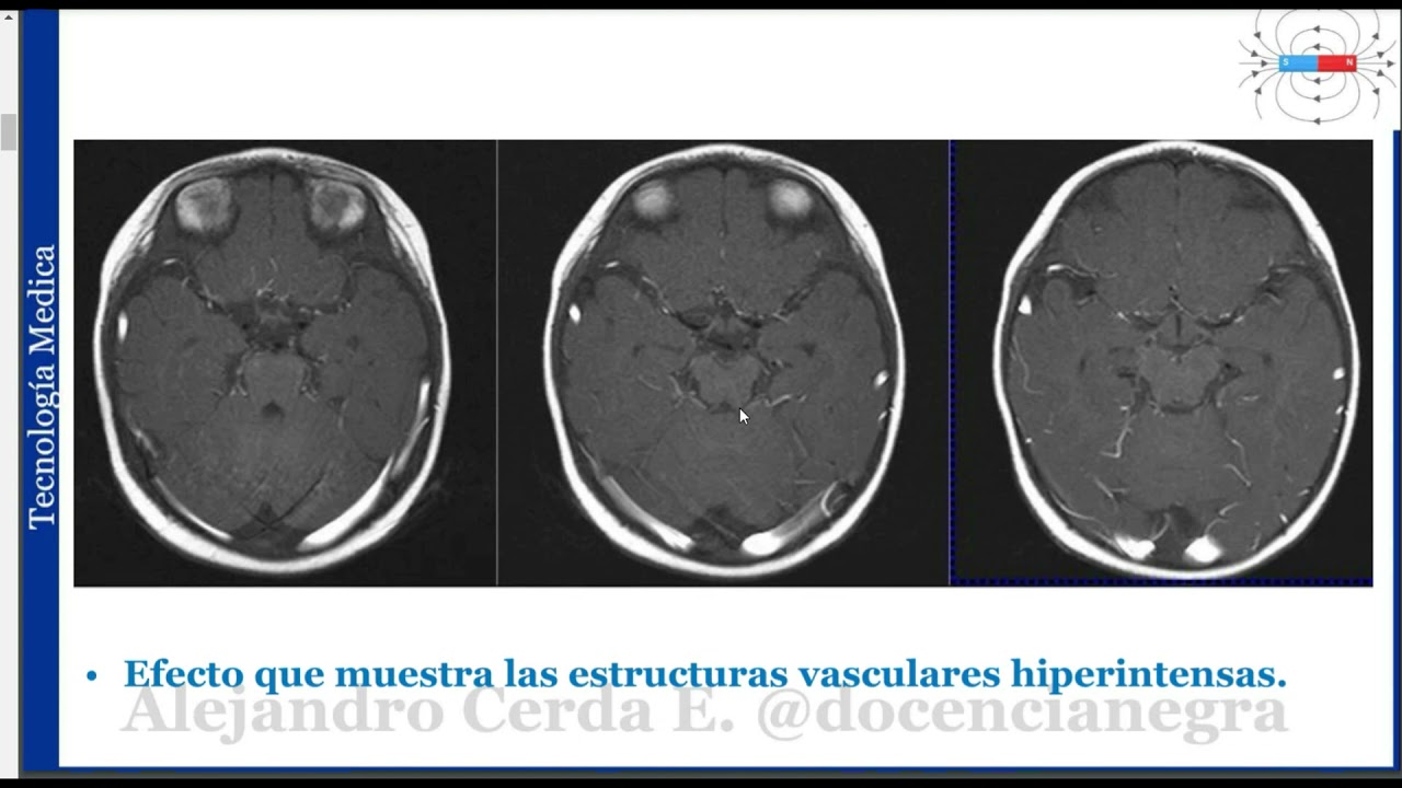 CLASE ANGIOGRAFIA SIN CONTRASTE