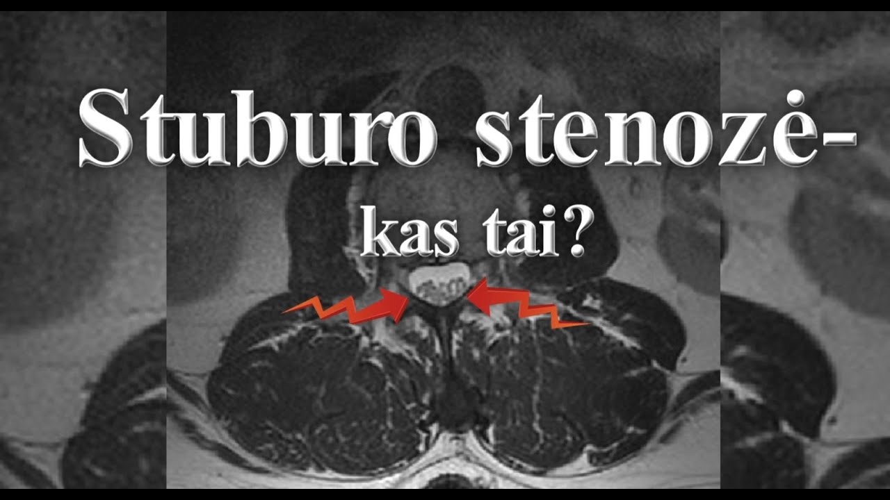 Stuburo stenozė  kas tai?