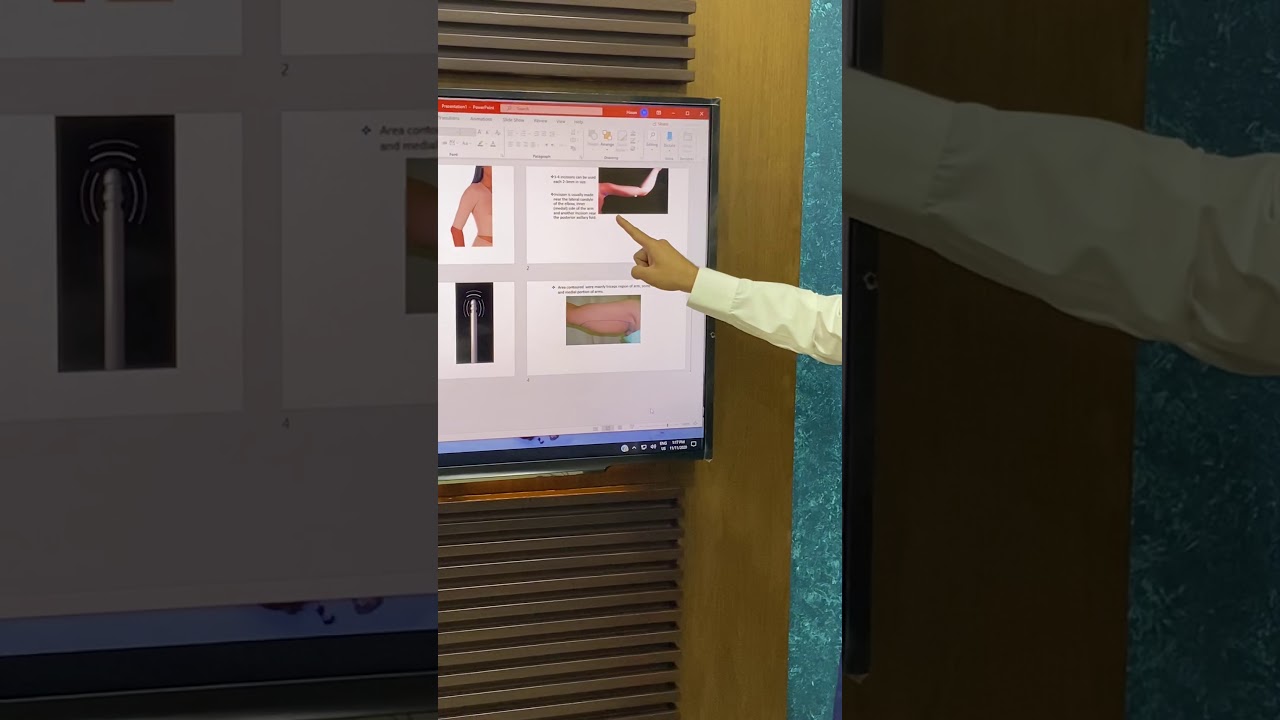 Arm contouring using VASER high definition Liposuction method