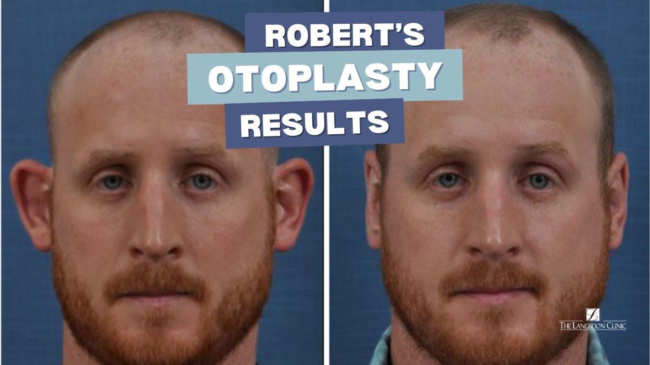 Robert's SHOCKING Otoplasty Results!