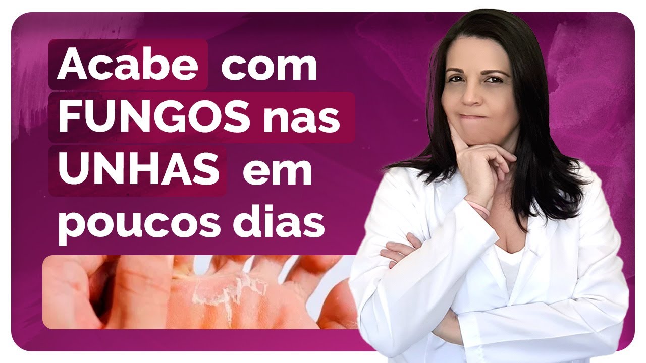ACABE com FUNGOS NAS UNHAS em POUCOS DIAS