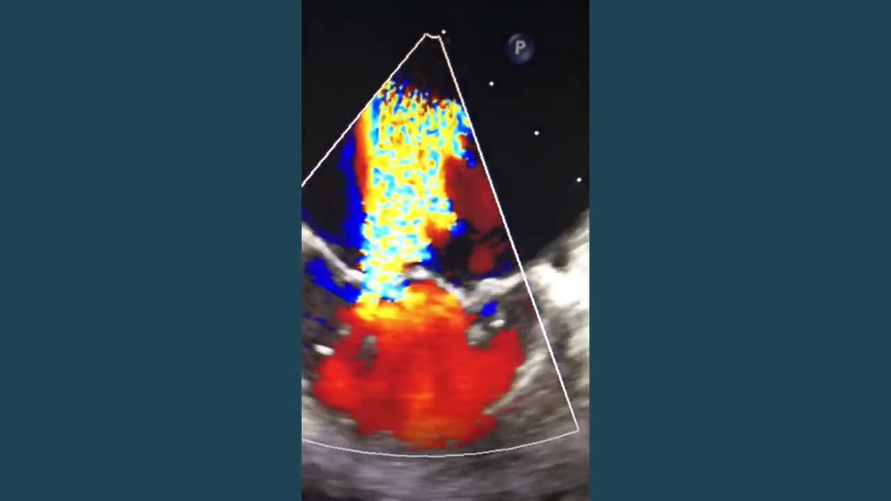 Mitral Valve Cleft with Severe MR (3D TEE Case)
