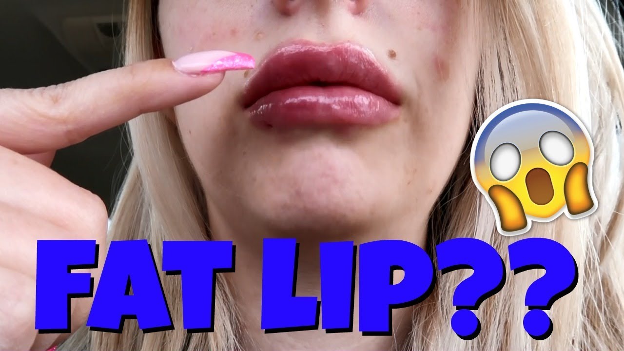 Got My Lips Done... AGAIN?!?