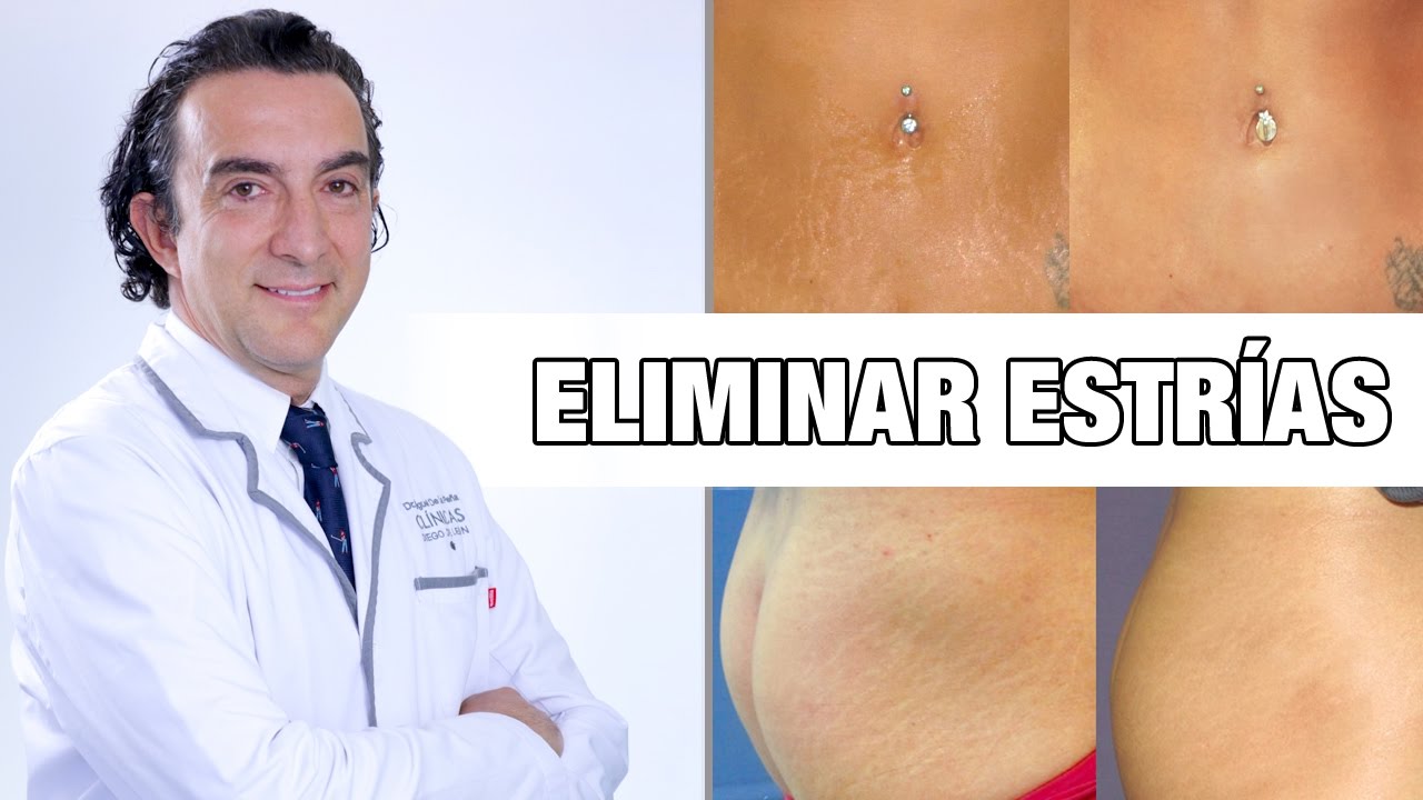 ¿Cómo eliminar las estrías? | Tratamiento Láser Fraxel Dual