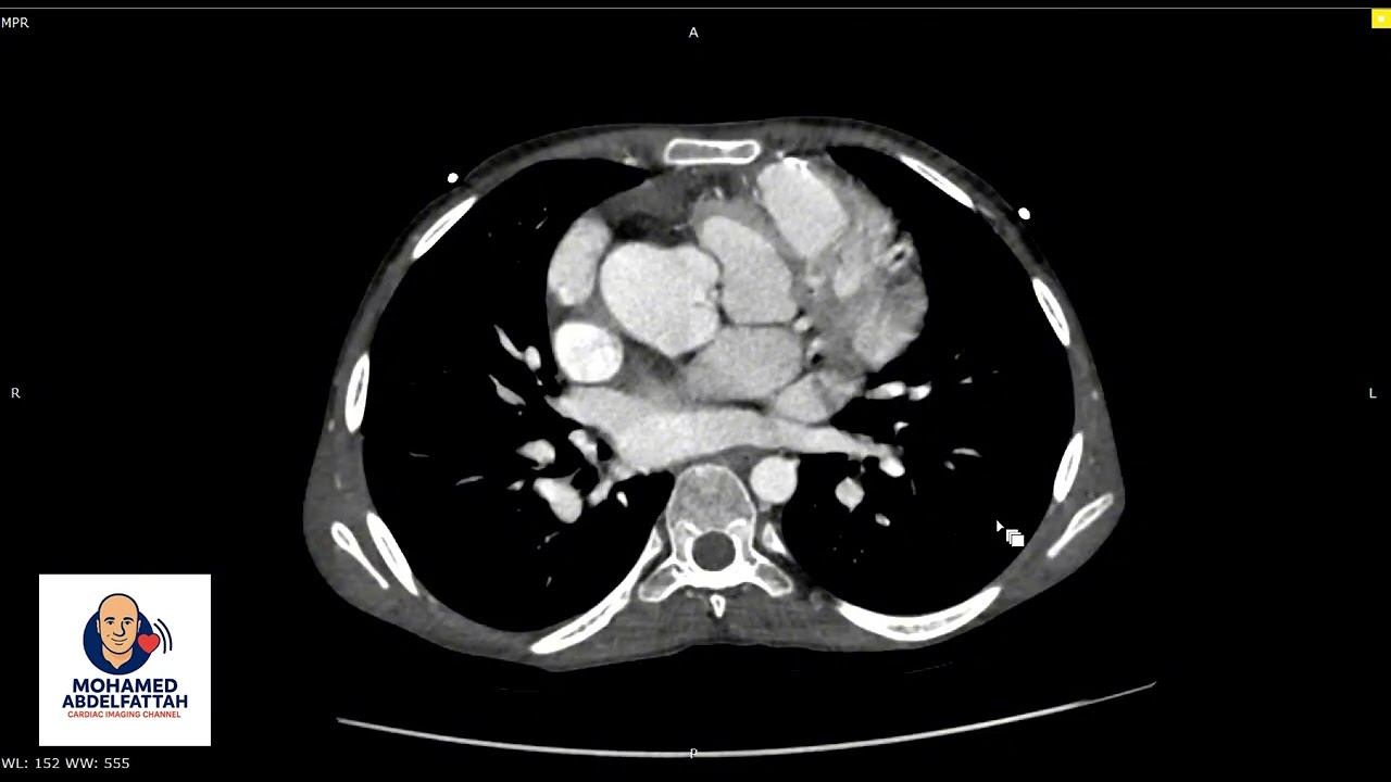 Double Barrel Technique in TOF with Coronary Artery Anomalies