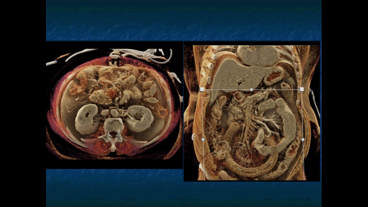 CT of the Acute Abdomen: GI Applications - Part 3