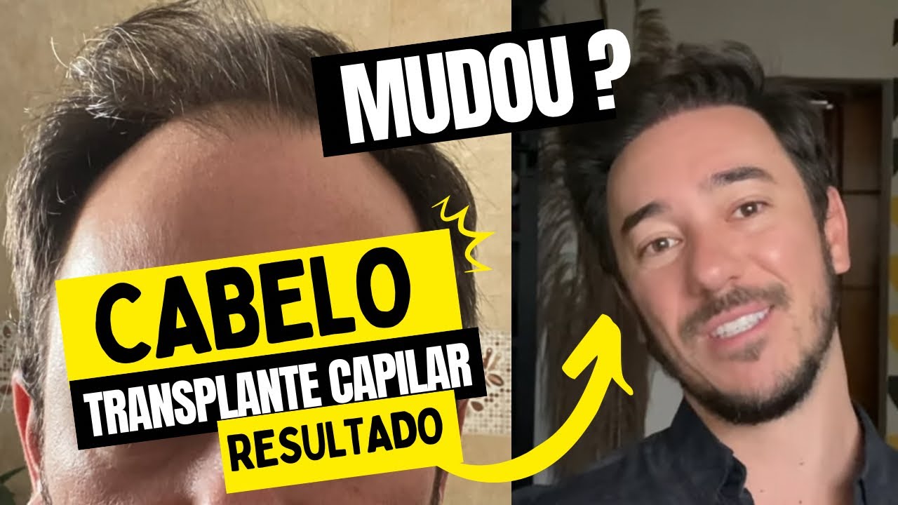 INCRIVEL RESULTADO FINAL TRANSPLANTE CAPILAR NO BRASIL
