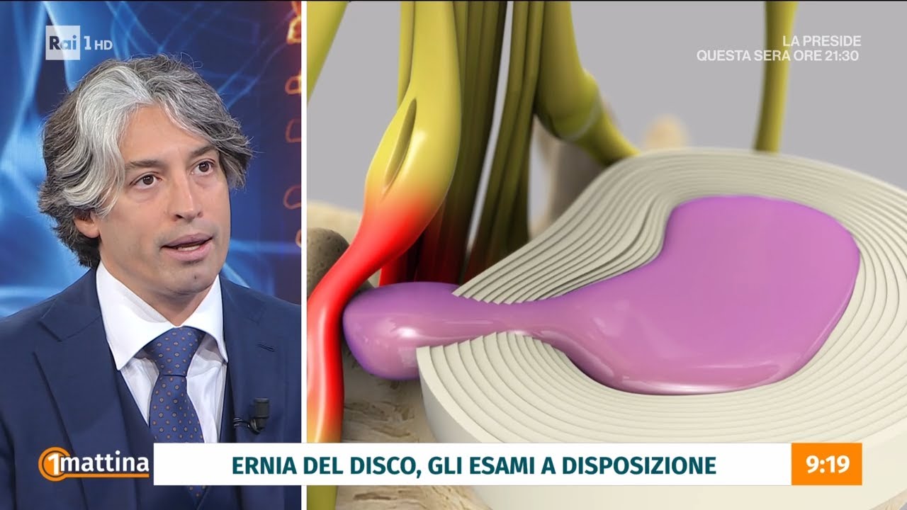 Ernia del disco:  i tempi di recupero dopo l&rsquo;intervento - Unomattina 26/01/2026