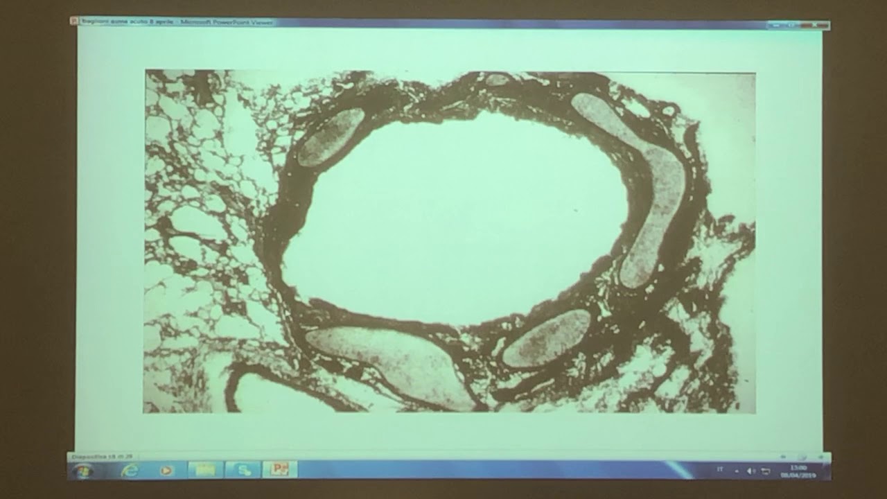 L’asma acuto nell’adulto e nel bambino - STEFANO BAGLIONI/FERNANDO DE BENEDICTIS