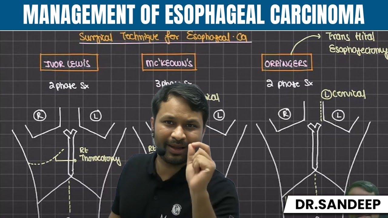 Management of Esophagus Carcinoma | Surgery | Bailey learned with Dr. Sandeep | PW MedEd