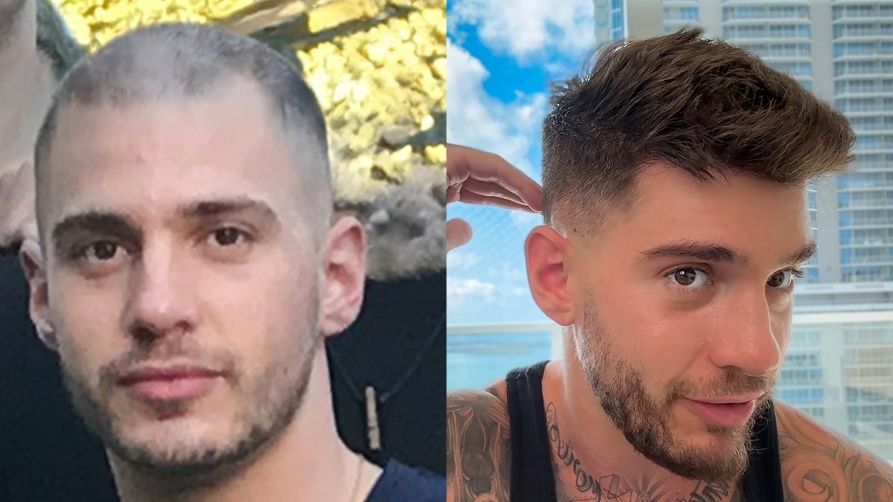 How I Reversed My Hair Loss