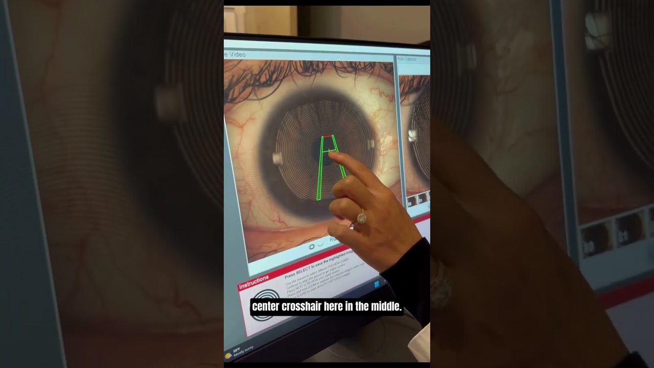 Corneal Topography Demonstration
