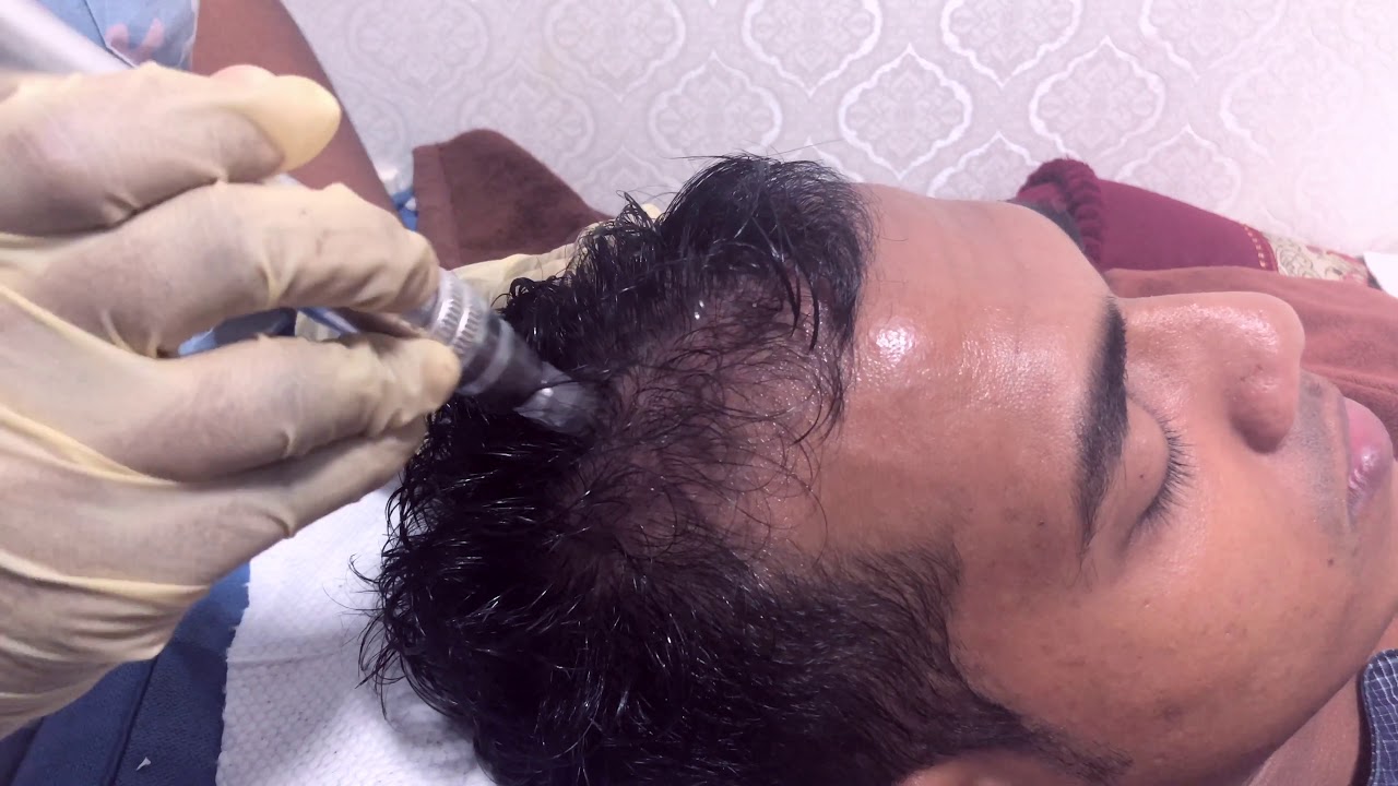 PRP FOR HAIRLOSS - Christell Skin Clinic