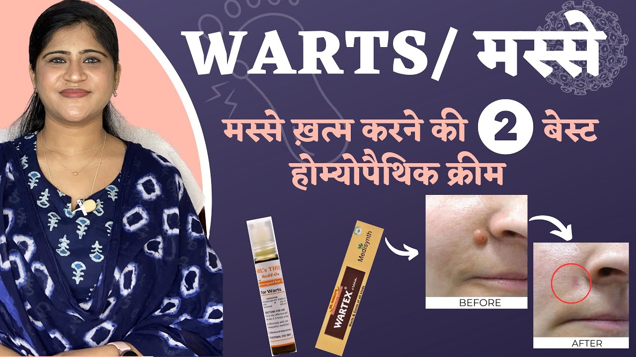 Warts/ मस्से : ख़त्म करने की 2 बेस्ट होम्योपैथिक क्रीम | Warts Homeopathic Treatment |Dr. Arwa Bohra