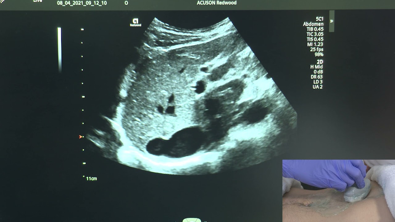 Ultrasound of the Pancreas
