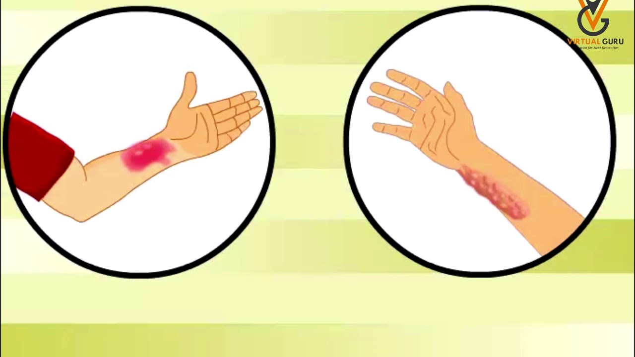 First Aid For Burns | Virtual Guru