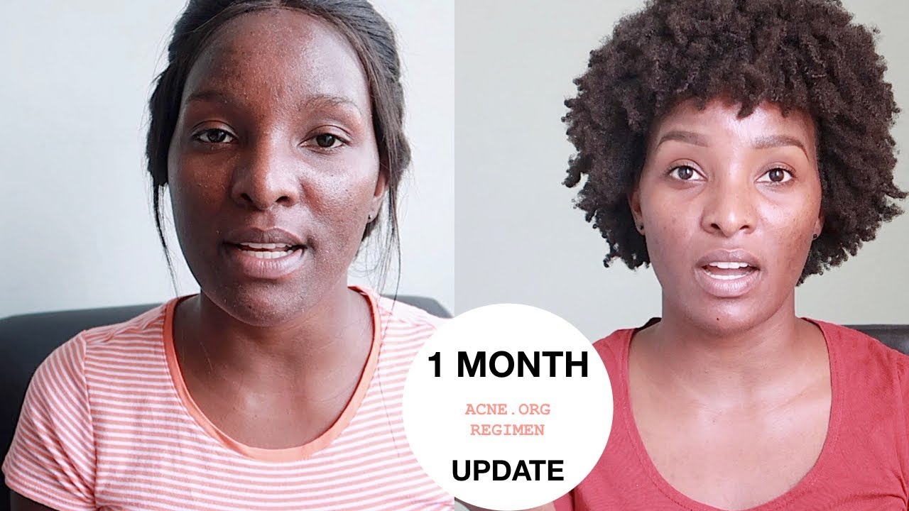 ACNE.ORG 1MONTH UPDATE WITH VIDEOS | BEFORE & AFTERS!🧡