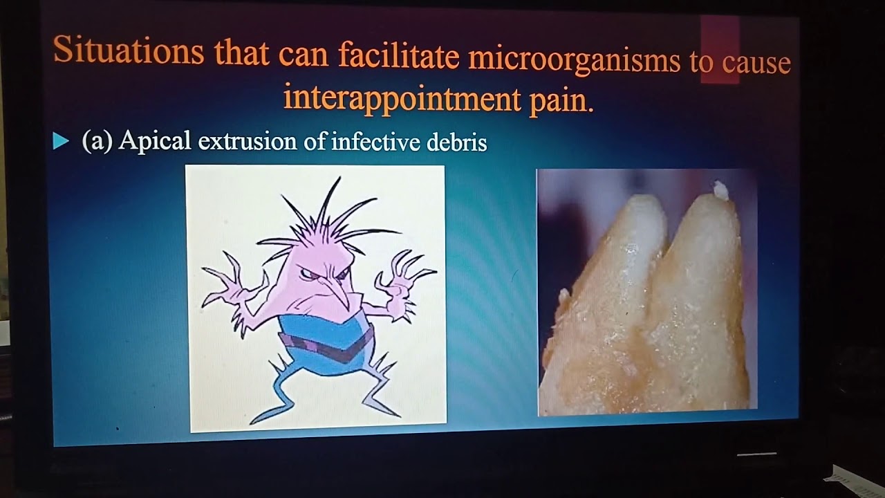 Management of Endodontic Flare up :Prof. Khaled Ali Beshr:High quality