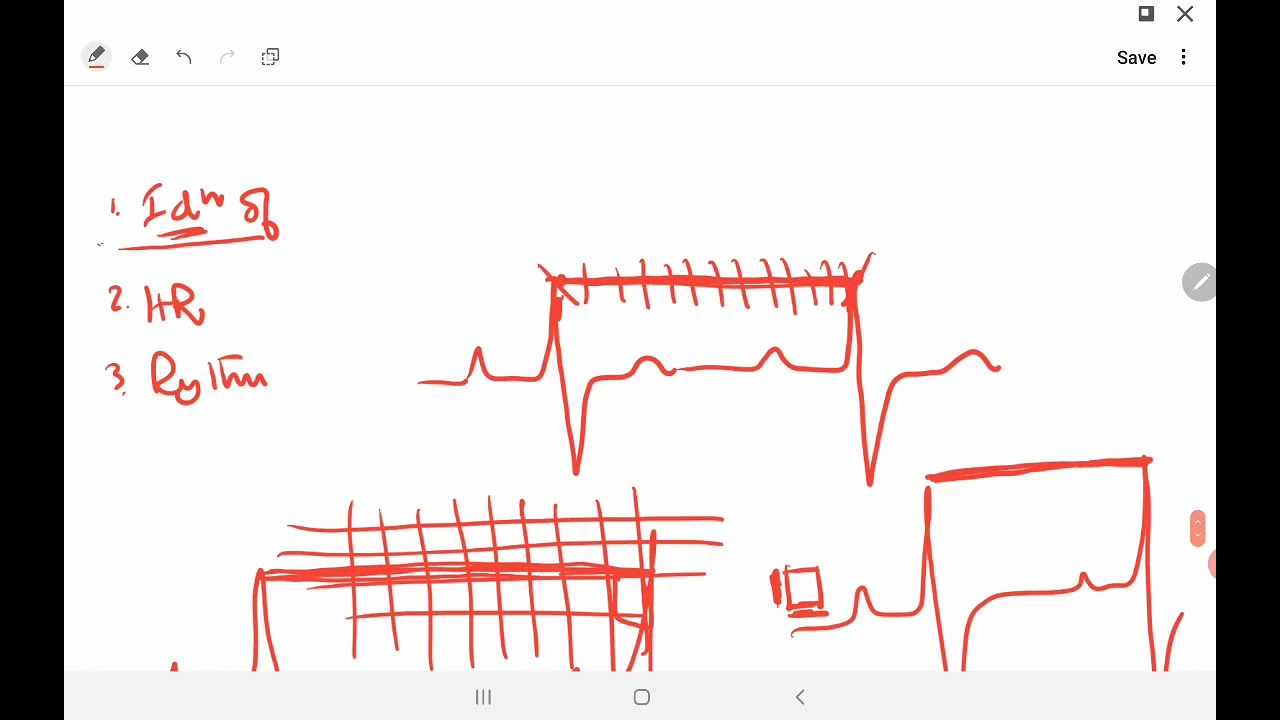 ecg 1