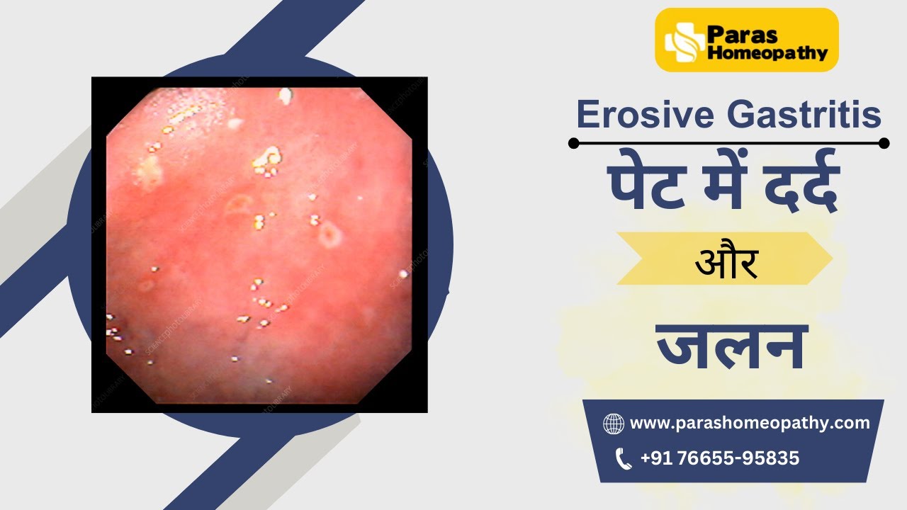 Erosive Gastritis क्या है, कारण, लक्षण और इलाज | Erosive Gastritis Treatment | Homeopathic Medicine