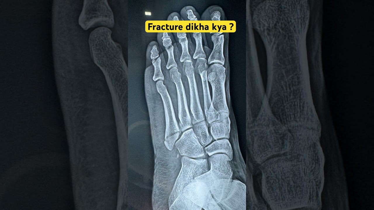 Isme fifth metatarsal ka fracture dikh raha hoga / aap batao comment karke