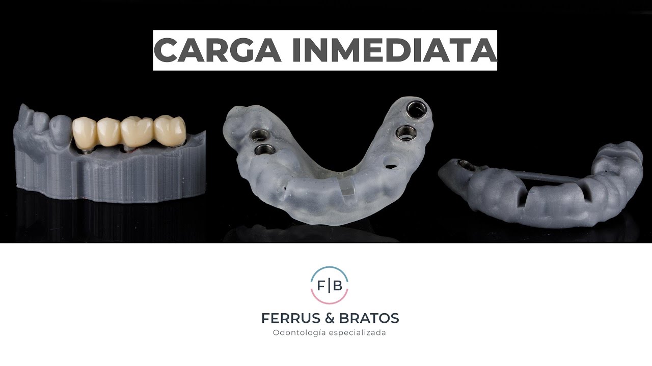 ¿IMPLANTES EN UN DÍA y SIN DOLOR? 🦷 Te cuento qué es la CARGA INMEDIATA